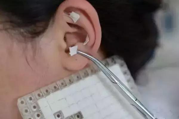 耳穴压豆治疗冠心病贴哪些穴位,冠心病如何通过2个穴位自救