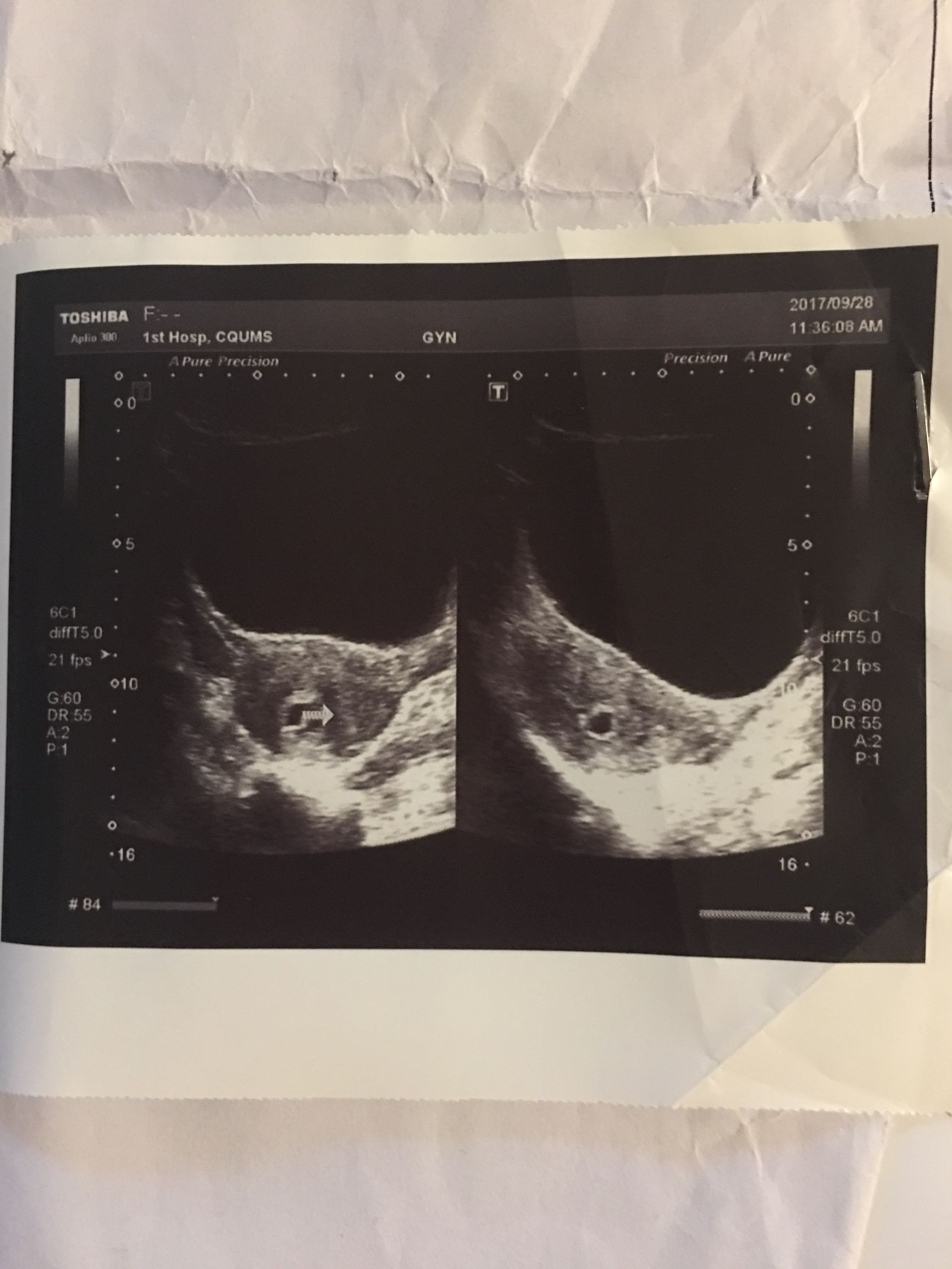 怀孕不易，保胎亦不易，顺利流产更是不易……