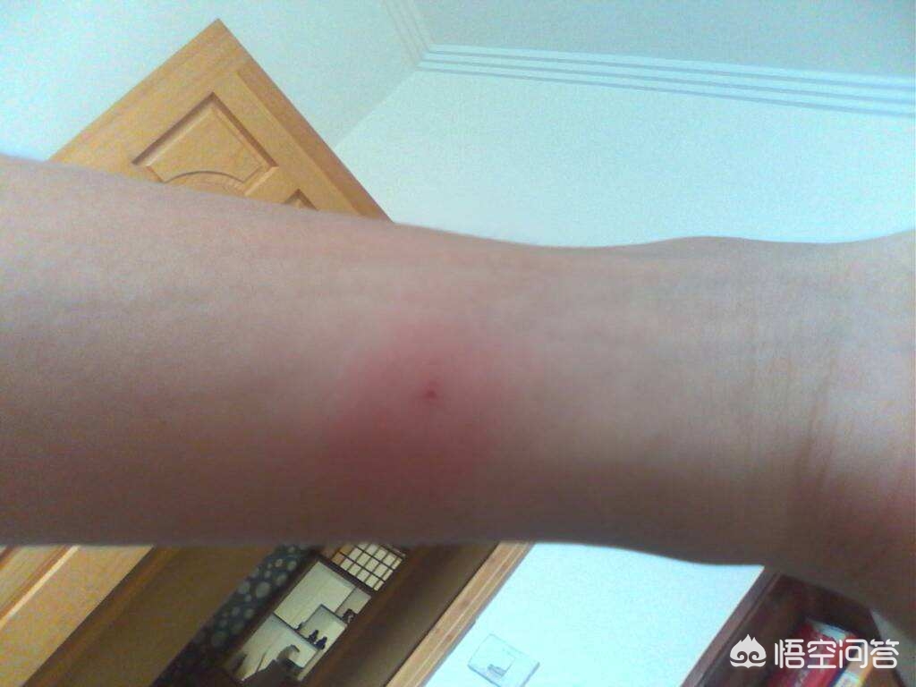 为什么从来没有感染过结核，也会出现结核菌素阳性