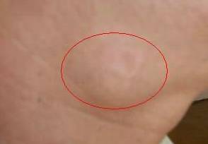 15岁鼻咽癌,患了鼻咽癌应该怎样饮食