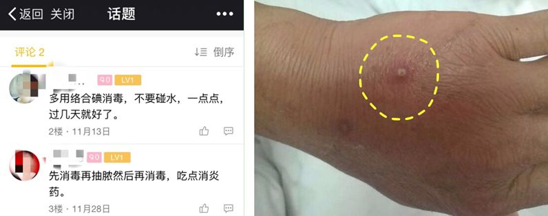 穿刺点感染怎么办？两种方法任你选