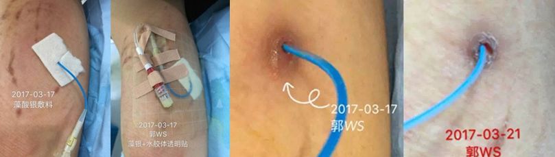 穿刺点感染怎么办？两种方法任你选