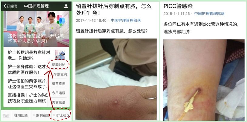 穿刺点感染怎么办？两种方法任你选