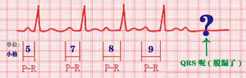 心电图秒懂,心电图零基础都秒懂