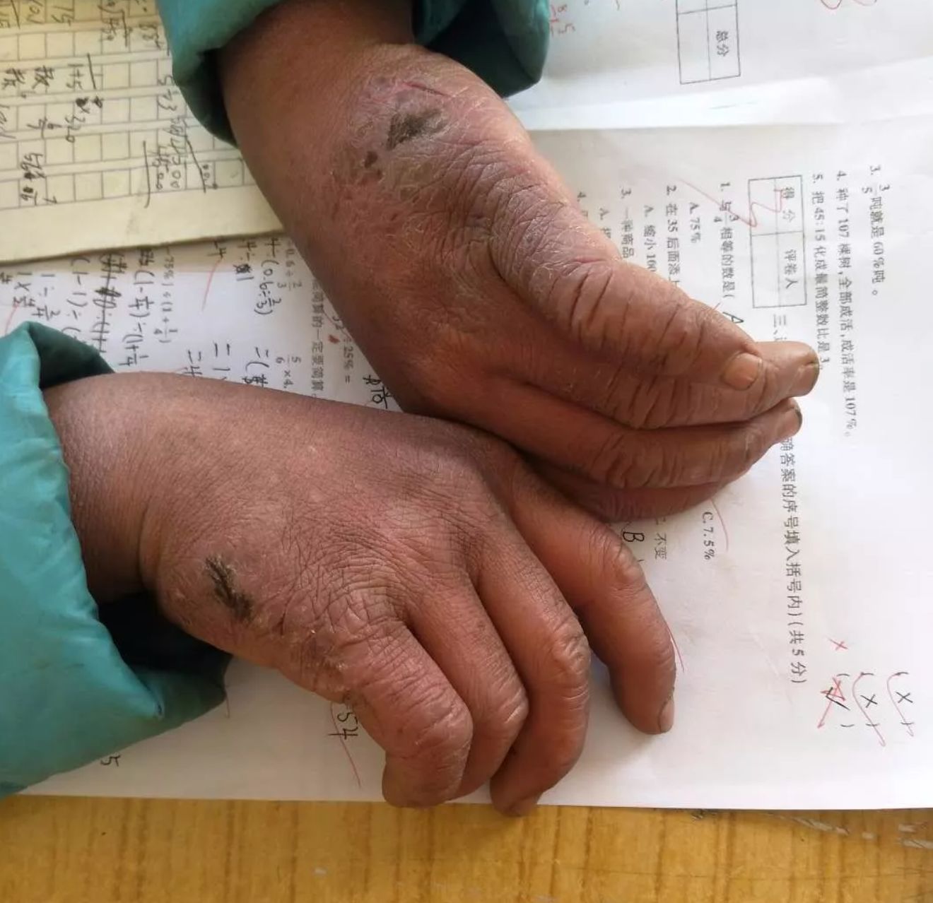 严重冻疮的快速消除方法,冻疮怎么预防护理