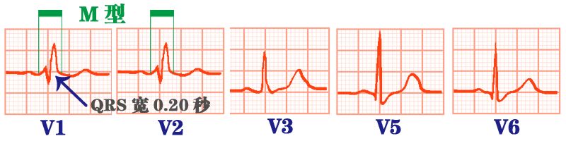心电图秒懂,心电图零基础都秒懂