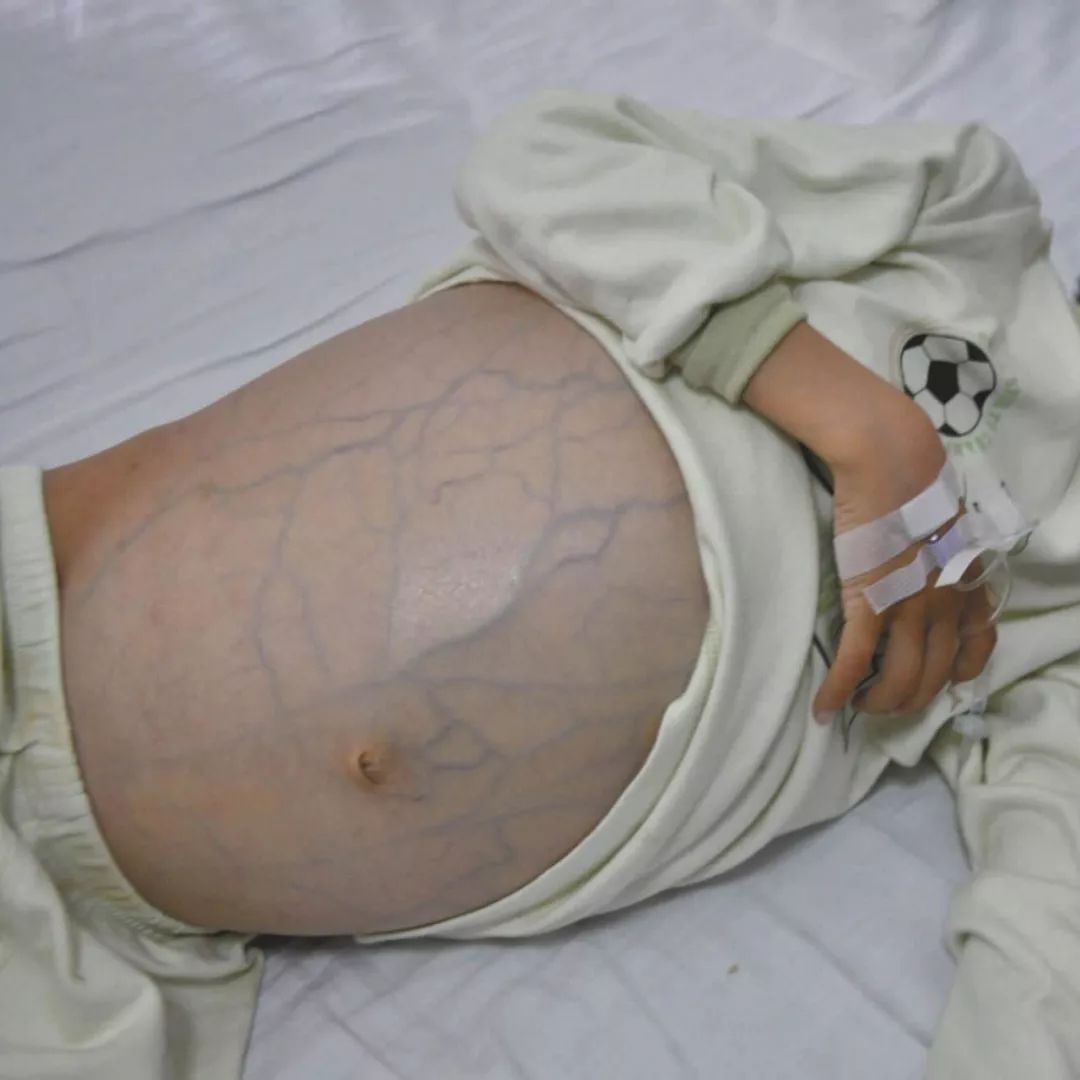 中医治疗恶性肿瘤腹水,腹膜后恶性肿瘤大量腹水能治好吗