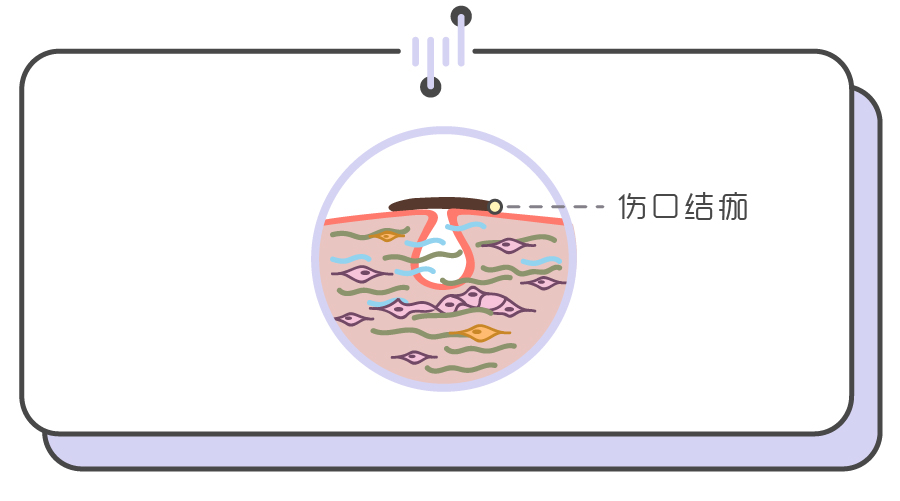 手把手教你正确挤痘不留坑,挤痘挤了个坑