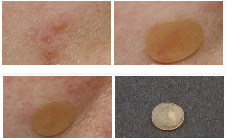 手把手教你正确挤痘不留坑,挤痘挤了个坑