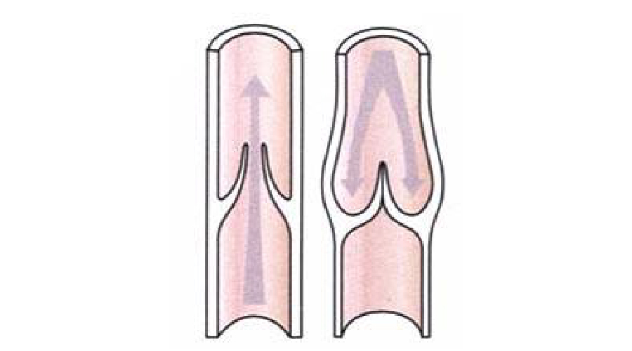 手把手教你正确挤痘不留坑,挤痘挤了个坑