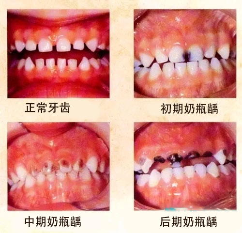 宝宝牙齿奶瓶龋怎么挽救,9岁孩子牙齿奶瓶龋怎么挽救