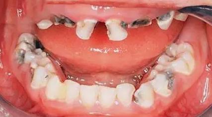 宝宝牙齿奶瓶龋怎么挽救,9岁孩子牙齿奶瓶龋怎么挽救