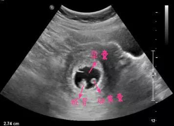 教你读懂产检b超单上英文缩写,如何看懂16周产检b超