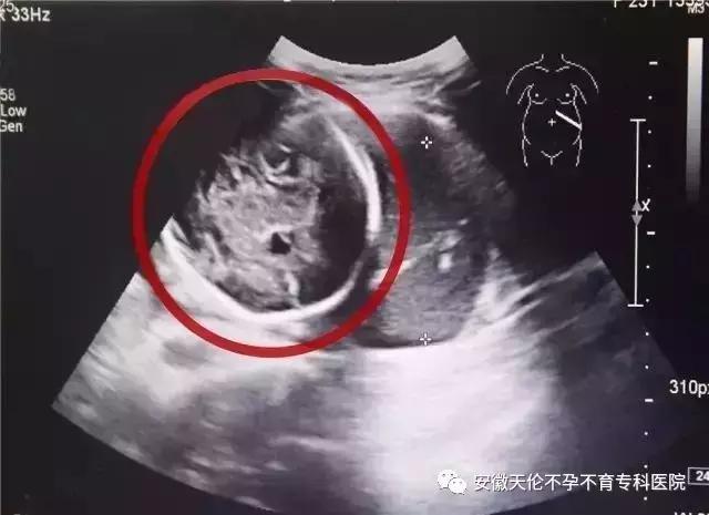 怀孕6周子宫内模样,孕6周子宫内多了一个无回声