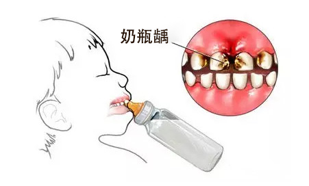 宝宝牙齿奶瓶龋怎么挽救,9岁孩子牙齿奶瓶龋怎么挽救