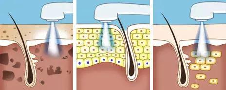 医美界的一键美颜，光子嫩肤真有神效吗？