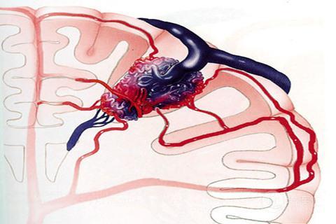 脑血管畸形立体定位治疗,脑血管爆破有救吗