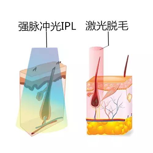 医美界的一键美颜，光子嫩肤真有神效吗？