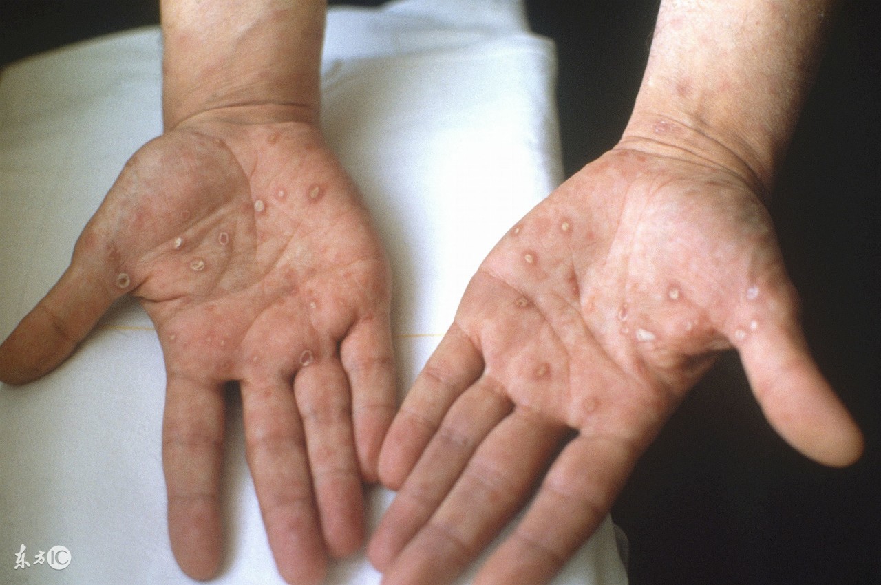 梅毒是怎么样才知道的,梅毒是怎么样的打一针多少钱