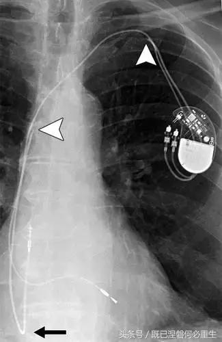 心内除颤仪和起搏器有什么区别,起搏器除颤仪