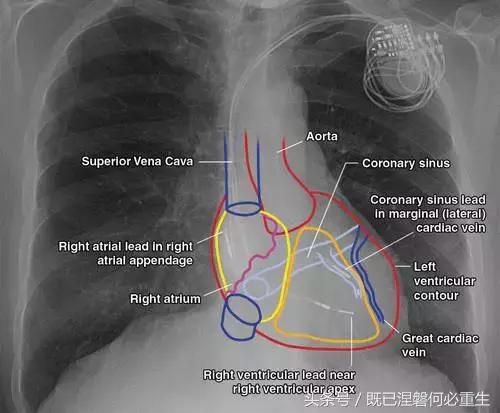 心内除颤仪和起搏器有什么区别,起搏器除颤仪
