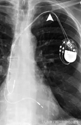 心内除颤仪和起搏器有什么区别,起搏器除颤仪