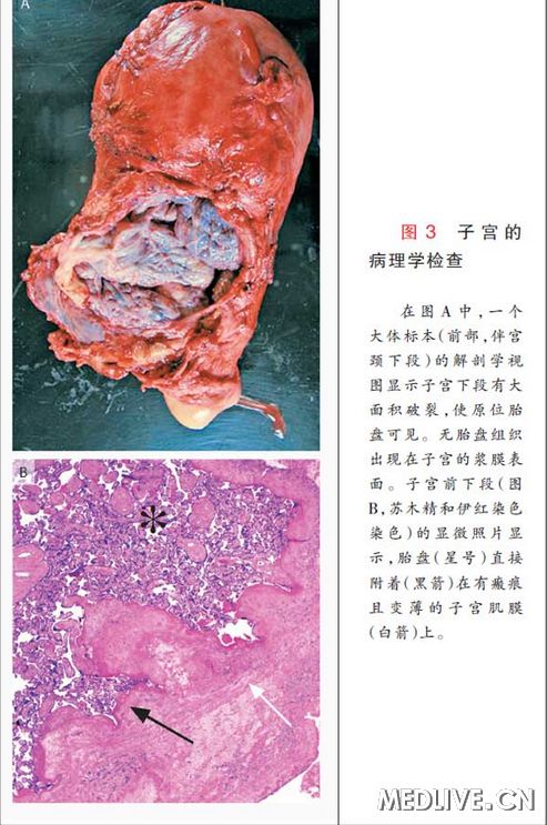 胎盘不正什么意思,胎盘不正为什么要住院