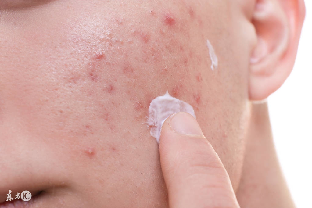 痘印去不掉？看完这篇价值一万块的痘印自救指南，你就会找到答案