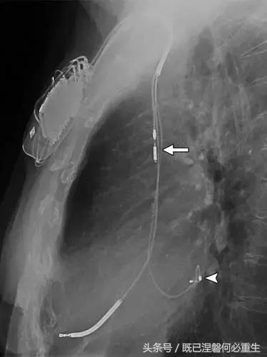 心内除颤仪和起搏器有什么区别,起搏器除颤仪