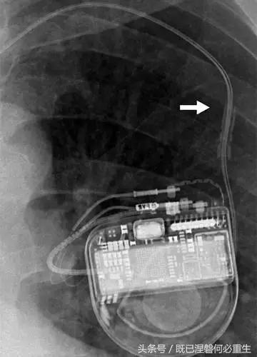 心内除颤仪和起搏器有什么区别,起搏器除颤仪