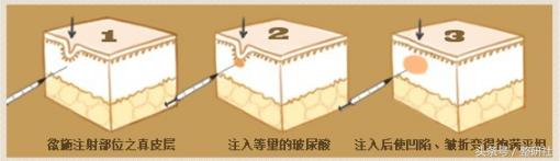 注射除皱案例,了解如何注射除皱