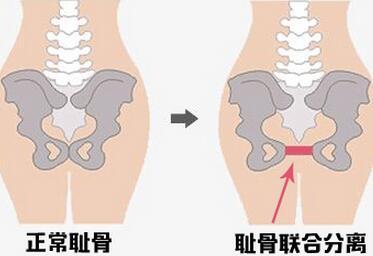 孕33周耻骨疼得厉害怎样才能缓解,孕晚期耻骨疼痛难忍一招帮你缓解