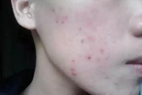 痘印去不掉？看完这篇价值一万块的痘印自救指南，你就会找到答案