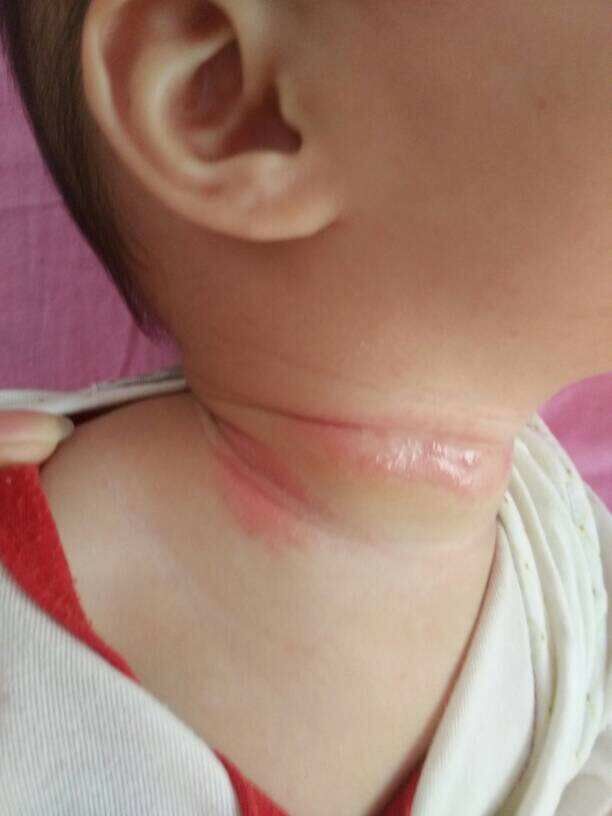 淹脖子脖子红怎么办,宝宝脖子淹红怎么晾脖子