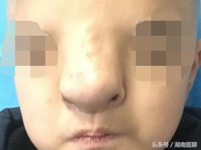 12岁小孩因长相太怪无法入学，尝试整形手术成功，父母热泪盈眶！