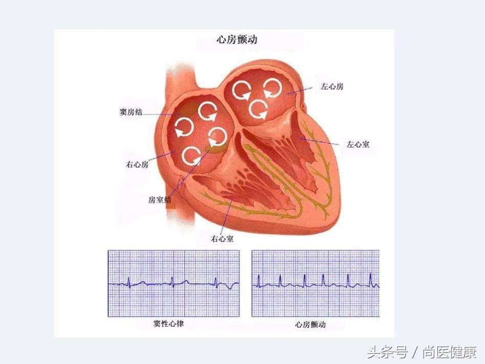 房颤的三大表现是什么,房颤的五大表现