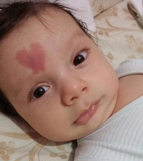 女孩子后背有胎记意义是什么,胎记的意义