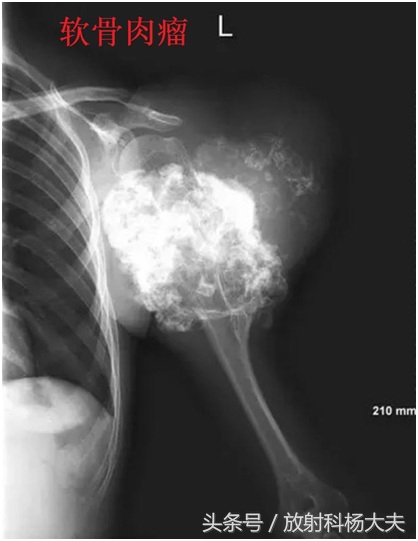 骨肉瘤是罕见病,和骨肉瘤相似的病