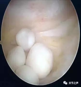 关节腔里长珍珠,关节附近长珍珠