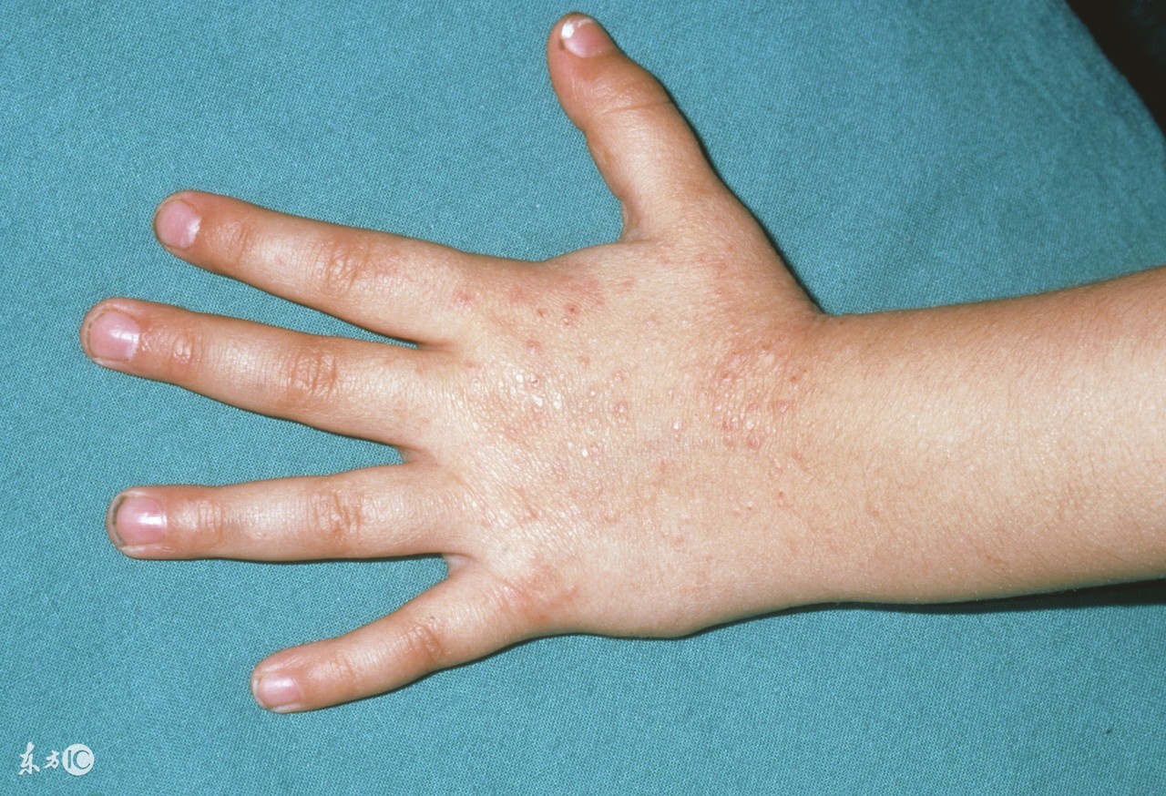 什么是接触性皮炎症状,什么叫接触性皮炎