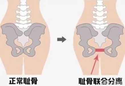 孕期耻骨痛应该多走路还是少走路,孕期耻骨分离痛怎么缓解