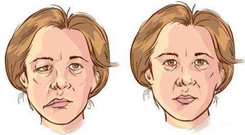 面瘫的正确护理方法,面瘫是怎么造成的怎么治疗