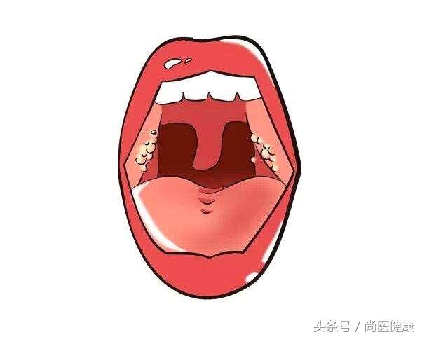 扁桃体反复发作有必要割掉吗,扁桃体一年发作一次需要切除么