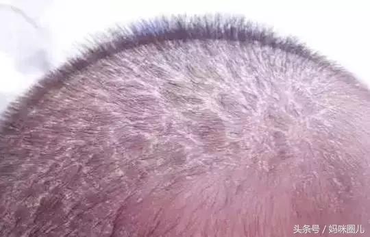 新生儿乳痂会长额头吗,新生儿额头乳痂多怎么除掉呢