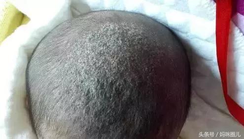 新生儿乳痂会长额头吗,新生儿额头乳痂多怎么除掉呢