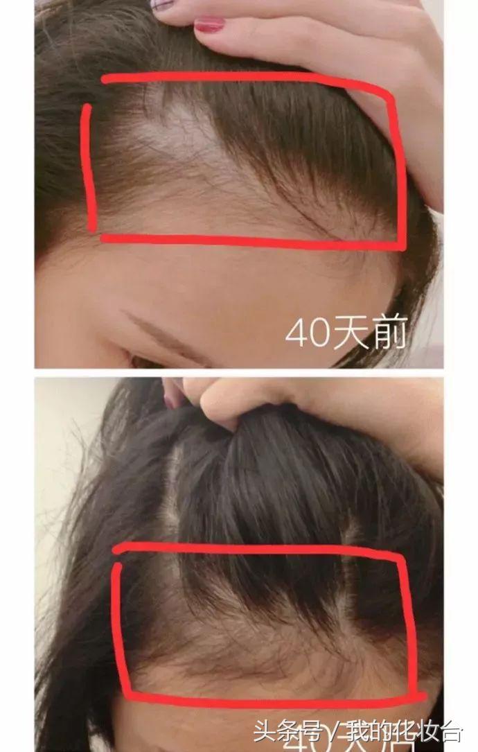 脱发严重怎么让头发蓬松,头发容易贴头皮教你一招