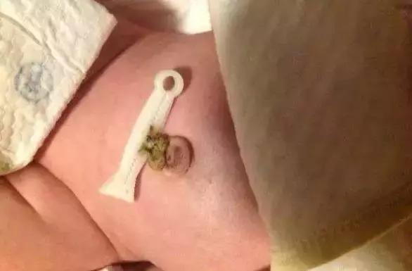 月嫂如何早发现新生儿脐部问题,月嫂给新生儿脐部消毒视频