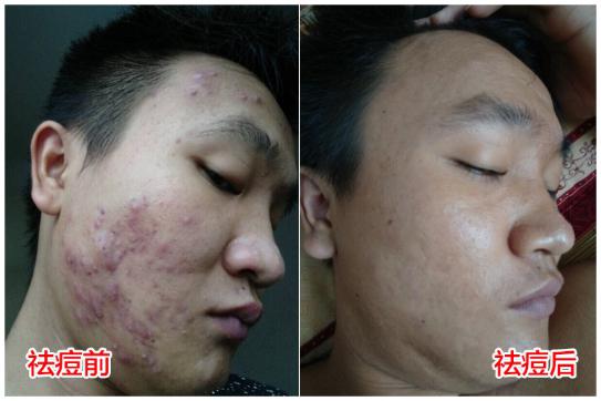 祛除痘印最有效的祛痘神器,祛痘神奇小妙招