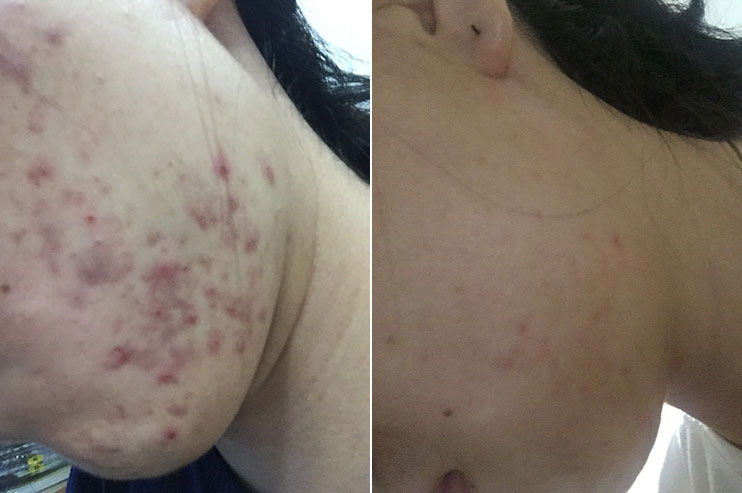 祛除痘印最有效的祛痘神器,祛痘神奇小妙招