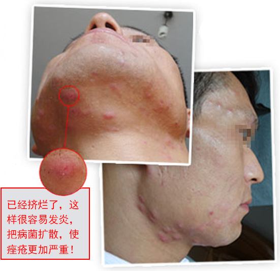 祛除痘印最有效的祛痘神器,祛痘神奇小妙招